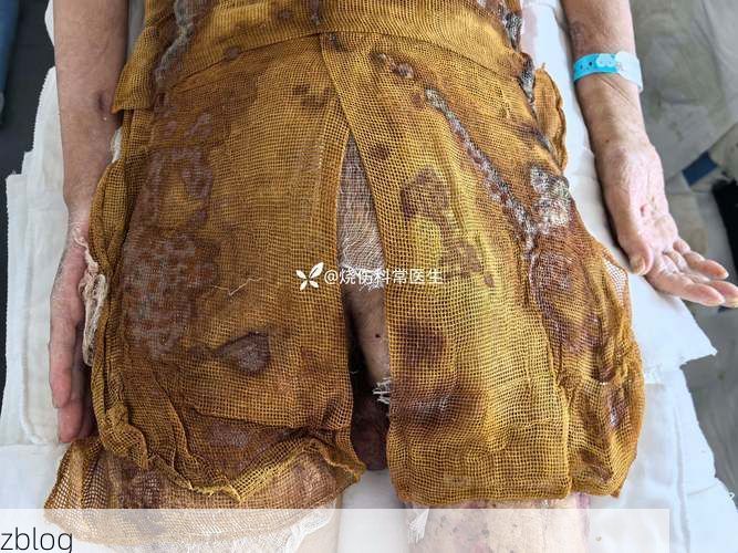 临洮：黄土高原隔离带下的低感染样本